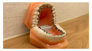 舌側矯正装置のイメージ