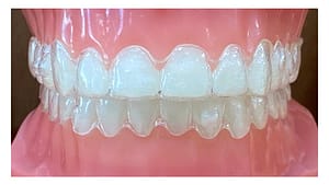 マウスピース型矯正装置のイメージ