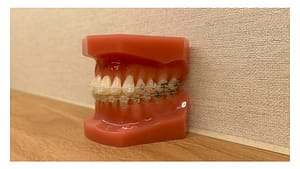 マルチブラケット装置の矯正イメージ